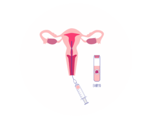 Embryo Transfer