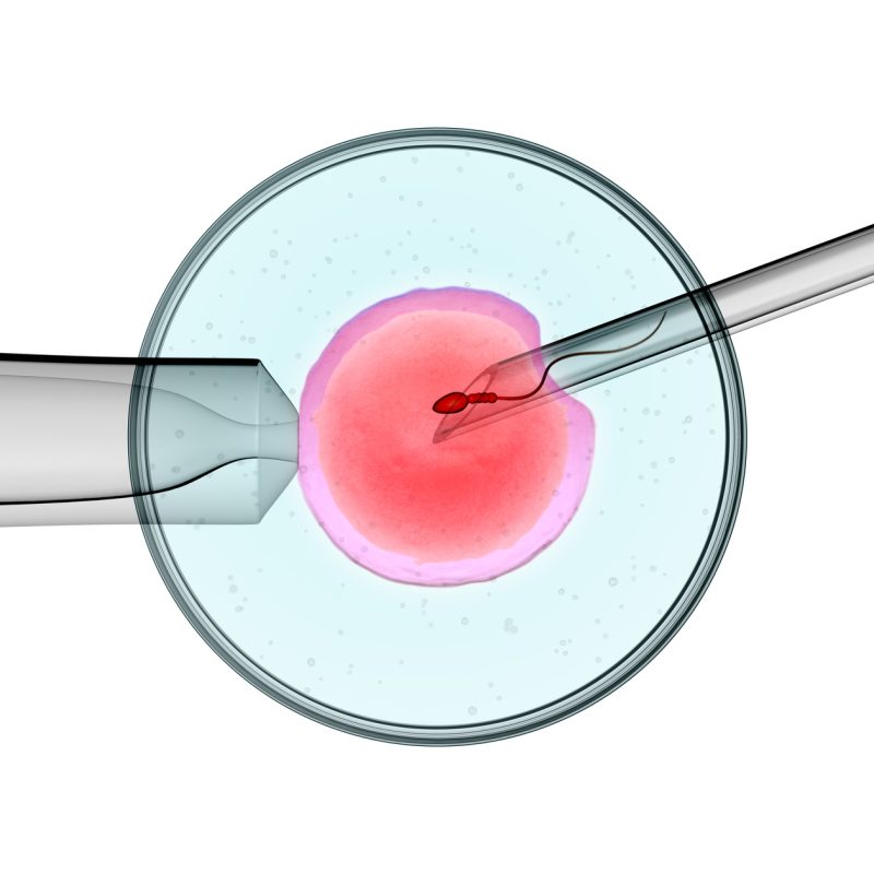 Intracytoplasmic Sperm Injection (ICSI) Treatment